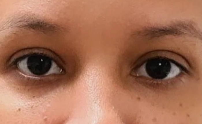 No Dia Nacional de Combate ao Glaucoma, SES-TO alerta para o diagnóstico precoce