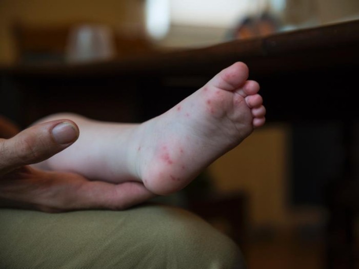 Semus alerta para circulação da doença mão-pé-boca