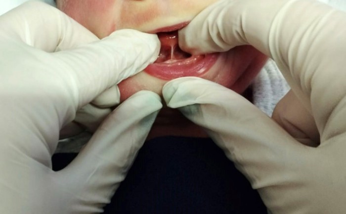 SES-TO enfatiza a importância do Teste da Linguinha