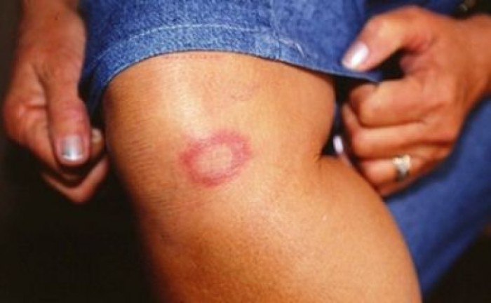 SES-TO realiza seminário sobre o manejo clínico de pacientes com hanseníase